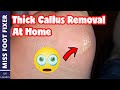 Thick Small Callus Treatment At Home By Miss Foot fixer Marion Yau [ 2022]