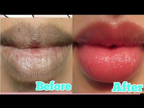 How To Get Rid Of Smokers Lips? 