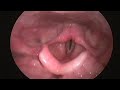 Laryngoscopy of  a normal adult #speechtherapy #throathealth #laryngoscope