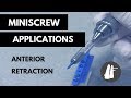 Miniscrew Applications: Anterior Retraction | Essential Biomechanics