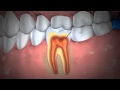 Treatment of abscessed teeth