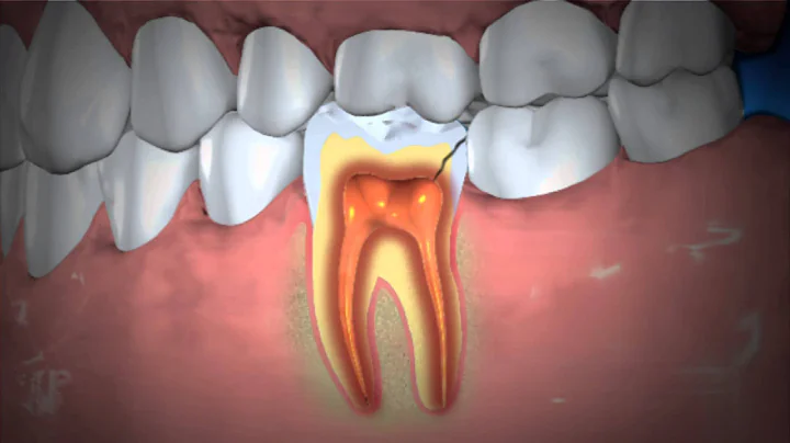 Treatment of Abscessed Teeth - DayDayNews