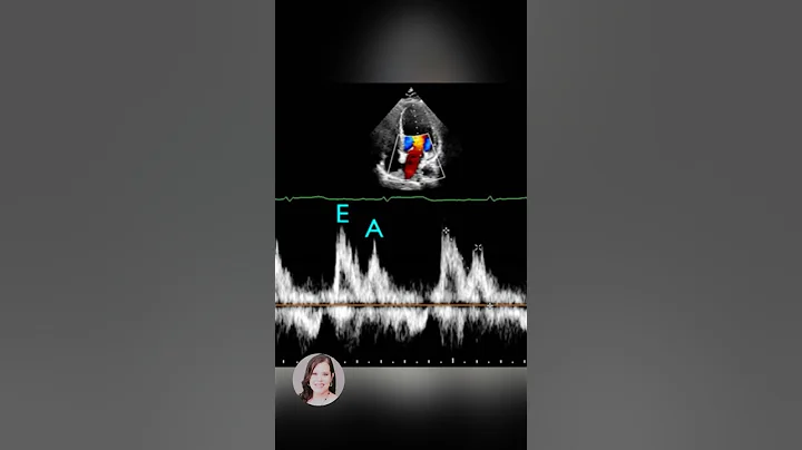 💓 Master the Mitral Inflow Pattern for Diastolic Function Assessment 💓