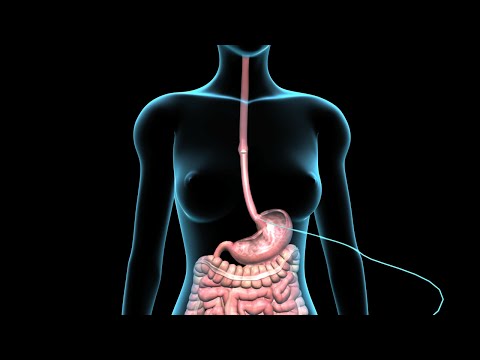 Vídeo: Inserción Del Tubo De Alimentación (gastrostomía)