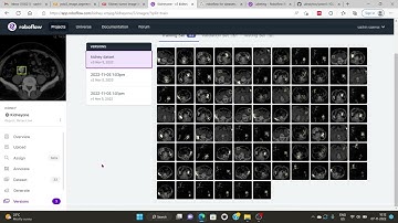 Kidney Tumor Segmentation using YOLOv5 in Pytorch | Stone Segmentation