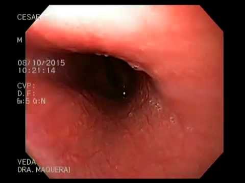gastritis cronica congestiva antral gastritis cronica congestiva antral