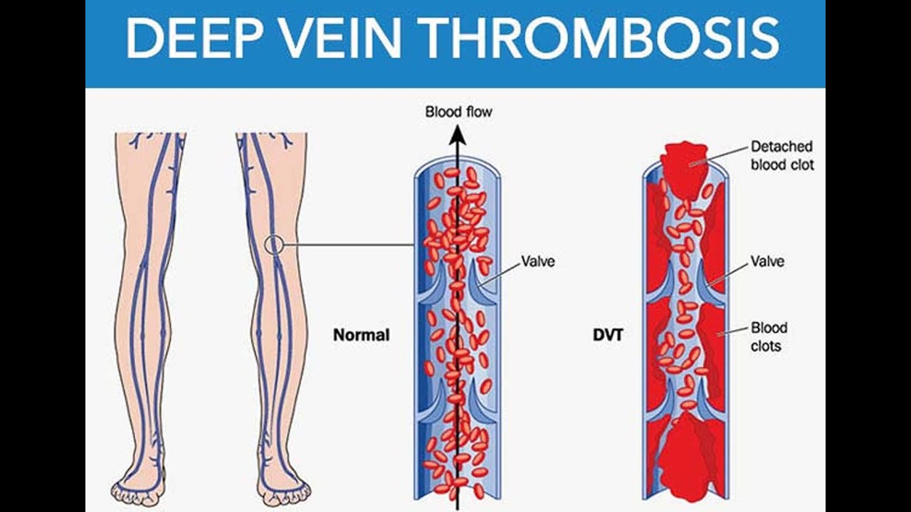 Deep Vein Thrombosis DVT Causes Symptoms Diagnosis Treatment Deep Vein Thrombosis DVT Causes Symptoms Diagnosis Treatment
