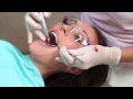 Hygienist Visit, Full Mouth Dental Cleaning