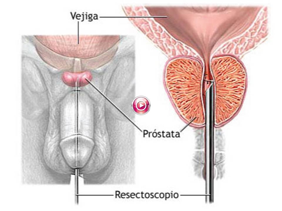 Operacion de prostata en que consiste