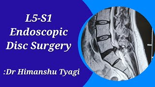 L5-S1 Endoscopic Disc Surgery (Slip disc operation\/herniation\/Disc prolapse\/extrusion\/Sequestration)