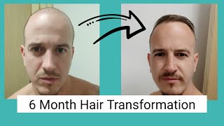 6 months into my hair transplant and everything in-between | Dr.Cinik hair transplant | Istanbul
