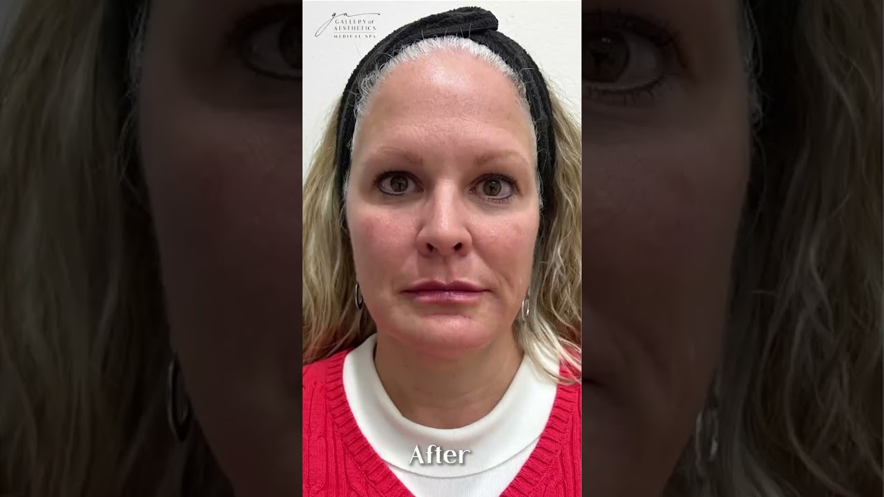 We're loving this transformation ft a full face of corrective filler!🤩