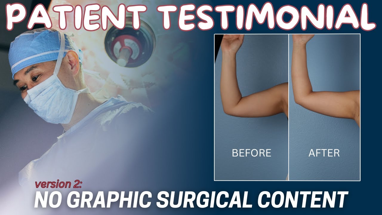 Patient Testimonial: Vaser Liposuction & Renuvion NO SURGICAL CONTENT