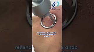 Laser CO2 como actua en la piel  #belleza #dermatólogo #láserco2 #pielbonita #fotona