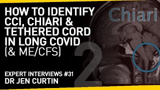 Do you have CCI, Chiari or Tethered Cord? The Symptoms to Look Out For with Long Covid or ME/CFS