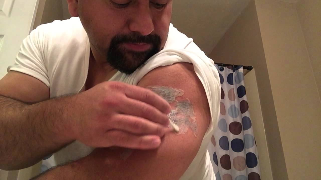 TCA 50 Tattoo Removal 1st Application Part 2 of 2