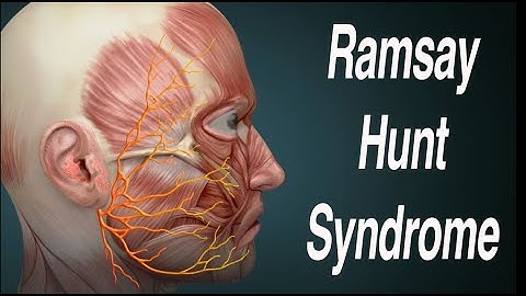 Ramsay Hunt Syndrome