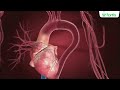 Stent vs Bypass Surgery: Which Heart Treatment Is Right for You?