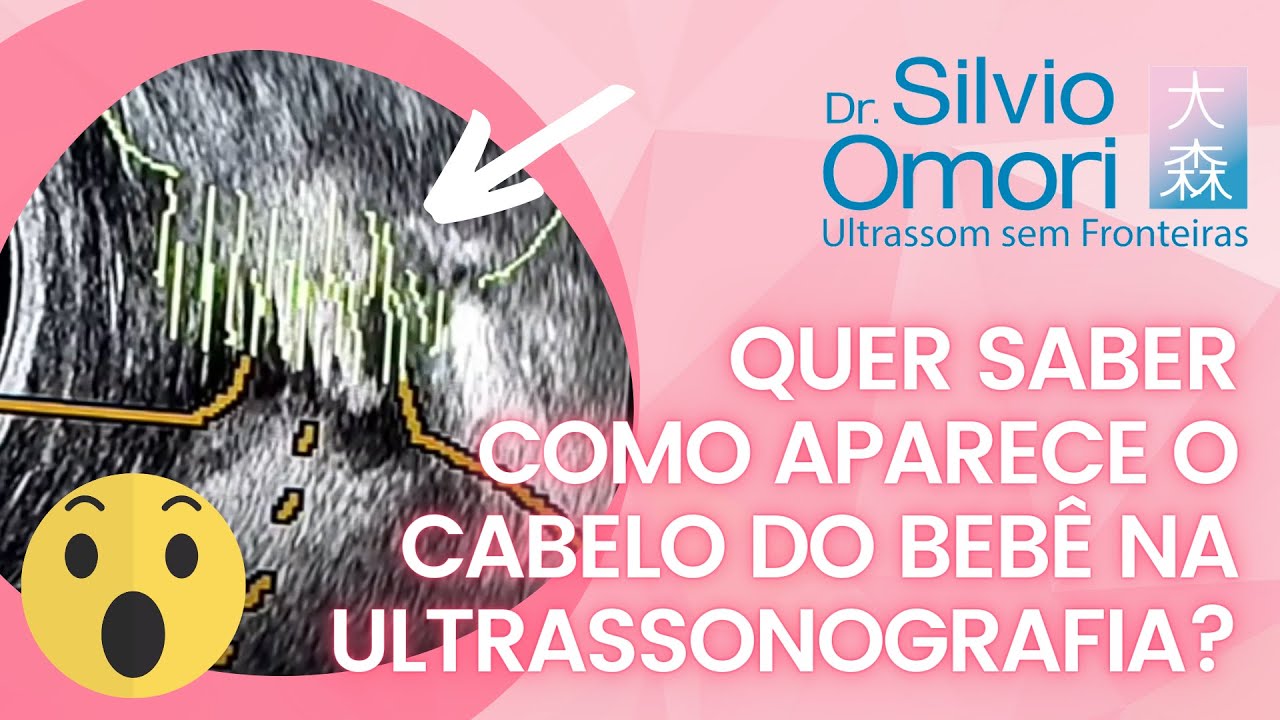 Quer saber como aparece o cabelo do bebê na ultrassonografia? - YouTube