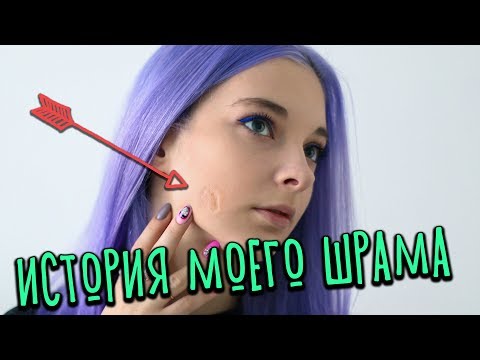 ИСТОРИЯ МОЕГО ШРАМА - ОТКУДА У МЕНЯ ШРАМ?
