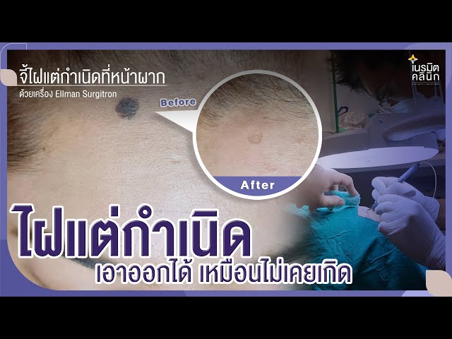 รีวิวตัดไฝ ขี้แมลงวัน EP.153/เม็ดใหญ่ตั้งแต่เกิดเอาออกได้นะ^^ @หมอปุ๊ NeramitClinic