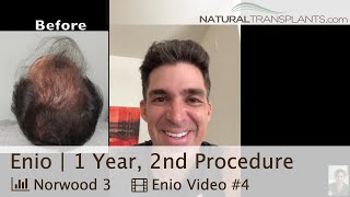 Wow! 1 Year After My 2nd Hair Restoration Surgery - 35% Increased Density | Dr. Rosenzweig (Enio)