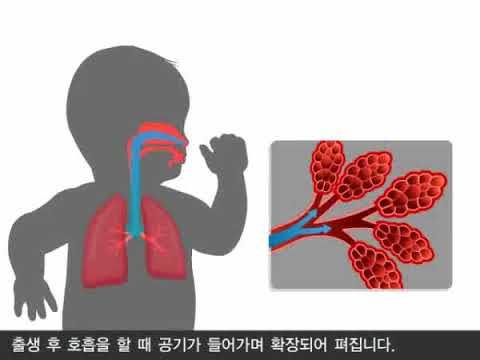 신생아호흡곤란증후군의 개념