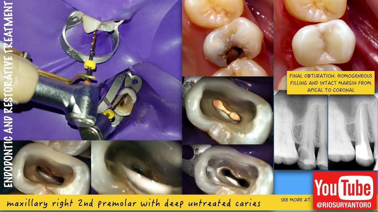 one visit root canal treatment one curve micro mega endodontic xtrabase voco passive ultrasonic
