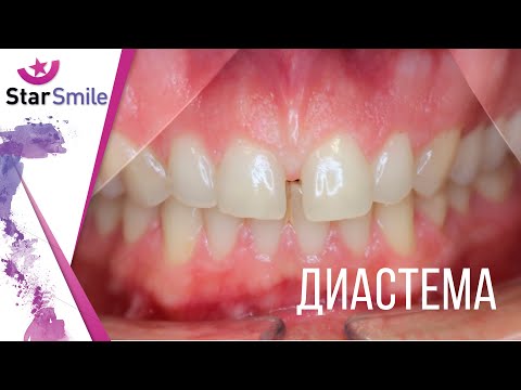 Видео: Диастема: зубы, лечение и наследственное