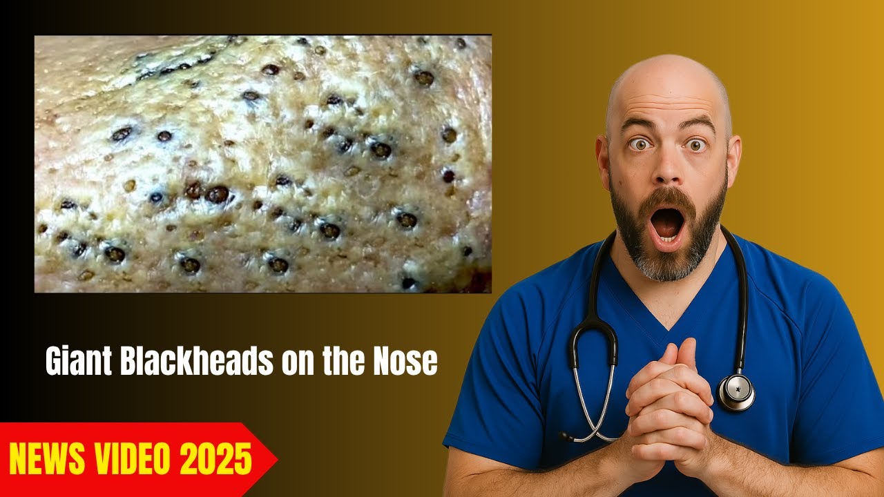 Dr. Jamie Lee Reacts to a Nose Covered in Giant Blackheads YouTube