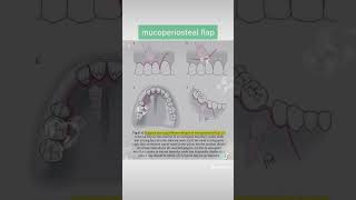mucoperiosteal flap