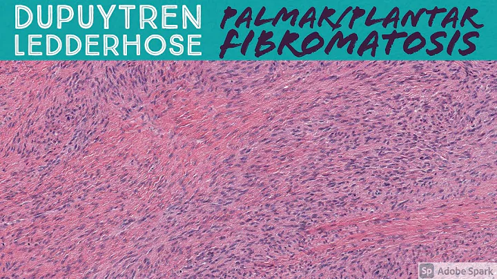 Palmar Fibromatosis (Dupuytren Contracture) & Plantar Fibromatosis: 5-Minute Pathology Pearls