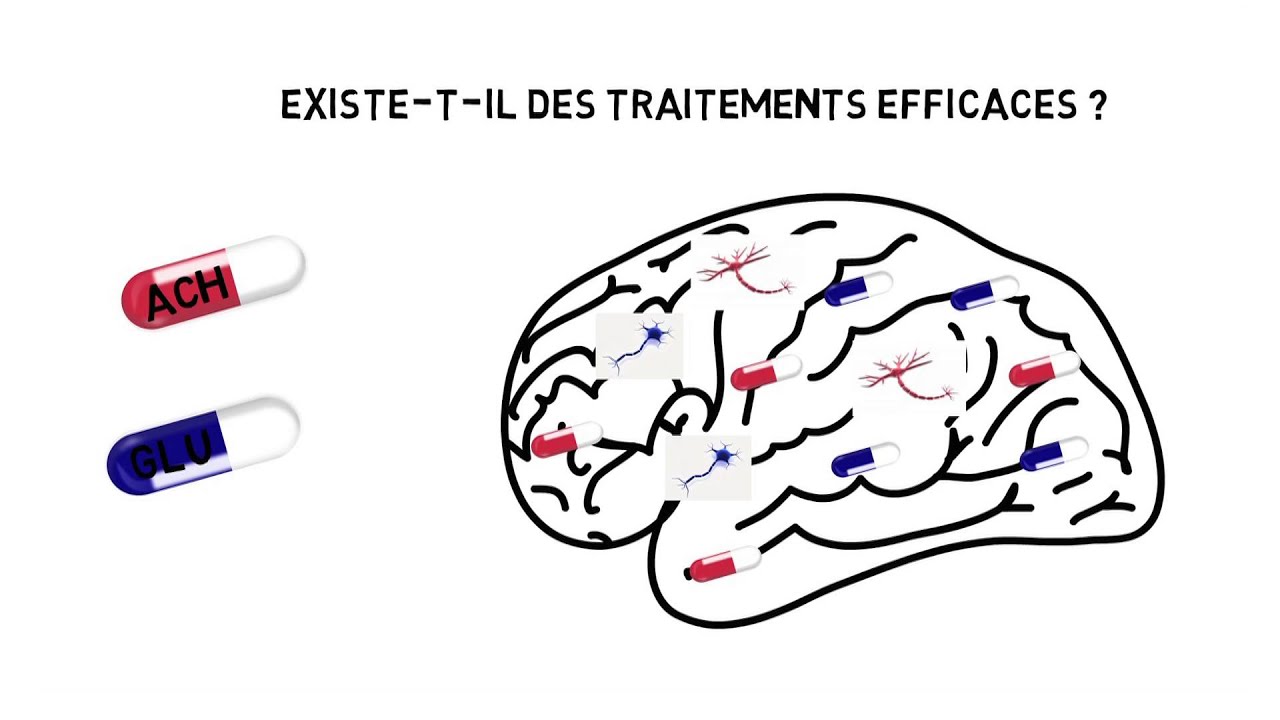 Maladie d’Alzheimer : existe-t-il des médicaments efficaces ?