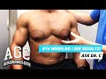 When Will I See Results After Gynecomastia Treatment? - Ask Dr. C - Episode 14