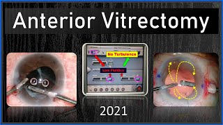 #009 Anterior vitrectomy ( basic phaco)