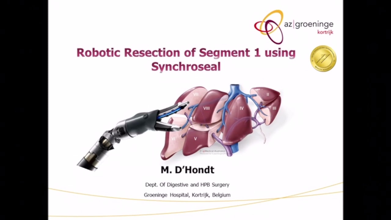 Robotic liver resection segment 1 using Synchroseal
