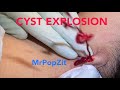 Juicy cyst explosion.MrPopZit gets popped. Neck abscess I+D under pressure, removed, flushed, packed