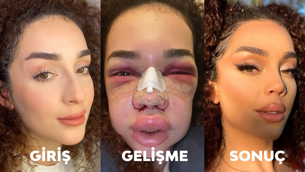 BİR BURUN AMELİYATI İLE NE KADAR DEĞİŞEBİLİRSİN? | ESTETİK SORU - CEVAP!