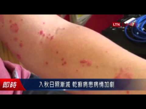 入秋日照漸減 乾癬病患病情加劇 - 入秋日照漸減 乾癬病患病情加劇