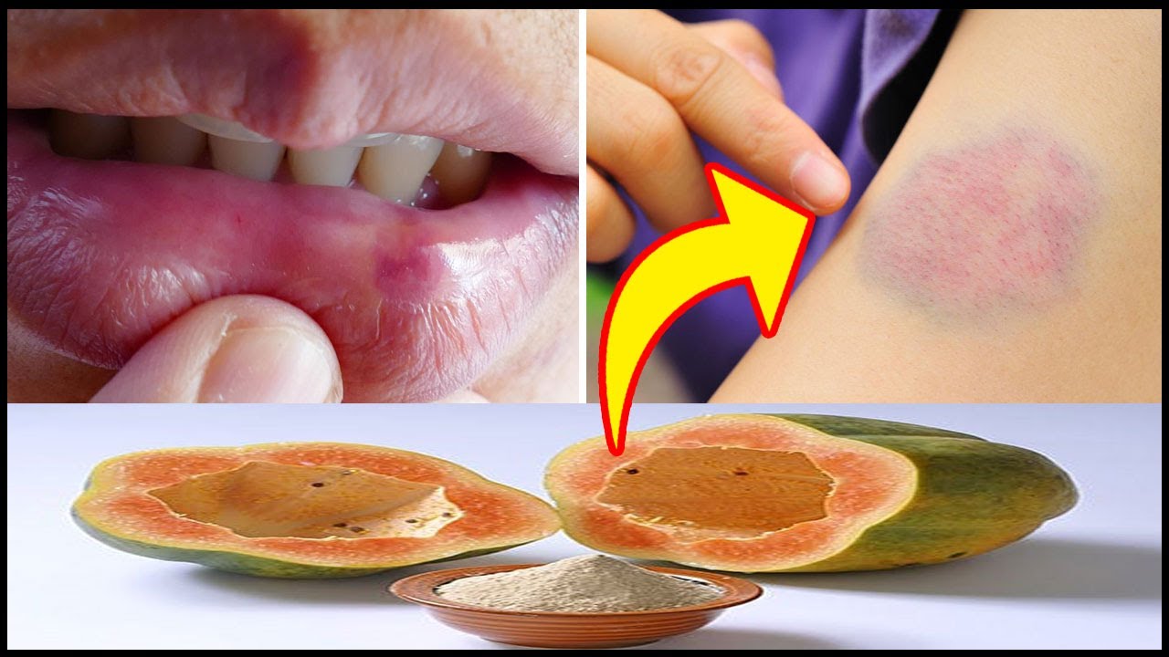 How to Get Rid Of Bruises in Just a Day Bruise on Lips and Face for