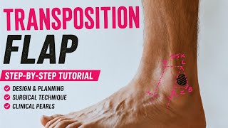 Transposition Flap Explained Step-by-Step | Flap Design, Planning & Surgical Technique |