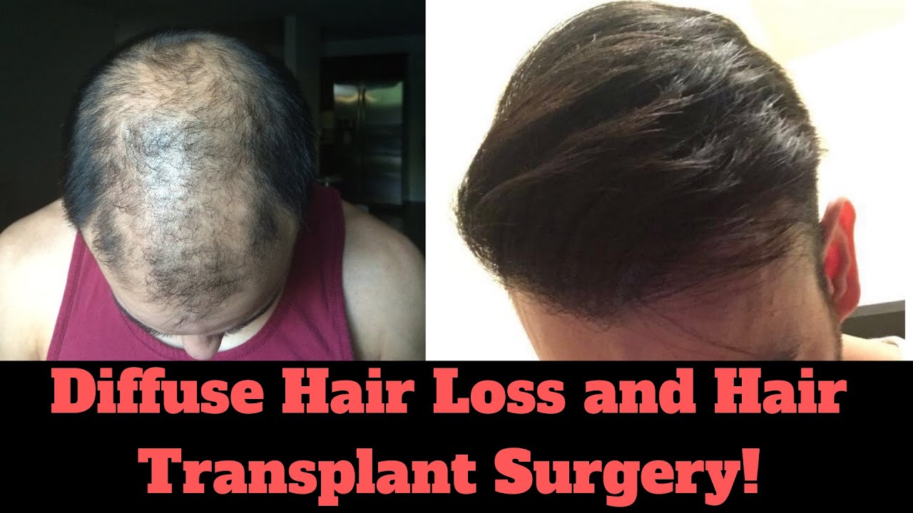 ❓Can you have a Hair Transplant with Diffuse Hair Loss? - YouTube