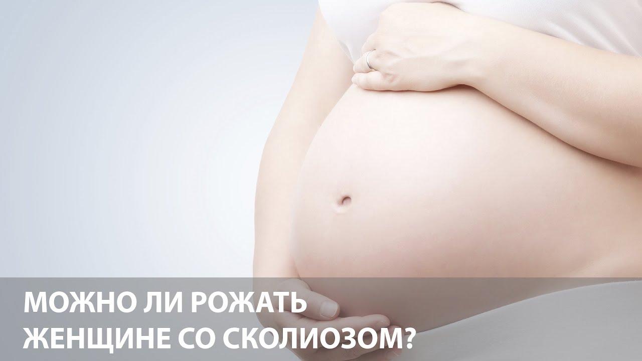 Можно ли рожать при сколиозе | Роды после операции по коррекции сколиоза