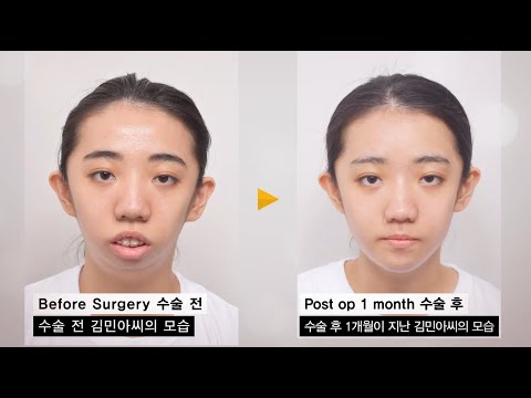 Micrognathia (Small Jaw) improve with double Jaw surgery (Before and After)