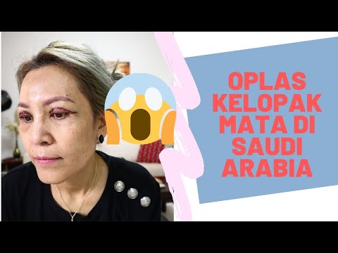 Video: Siapa Yang Harus Menjalani Blepharoplasty Kelopak Mata? Mari Bercakap Mengenai Bintang