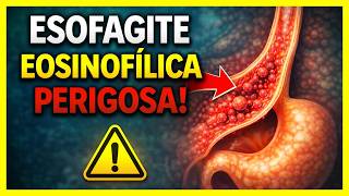 WARNING: EOSINOPHILIC ESOPHAGITIS may be harming you! DISCOVER THE SIGNS NOW #esophagitis