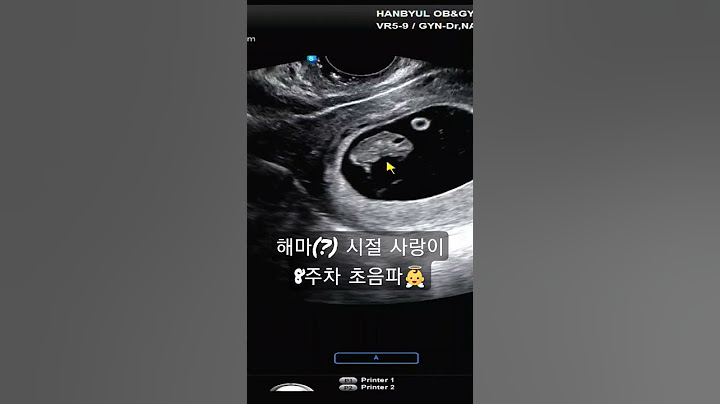 임신 8주차 초음파 영상 - 해마가 된 사랑이👼