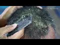 Fast And Easy Cleaning Big Flakes!! Most Satisfying Dandruff Removal #270
