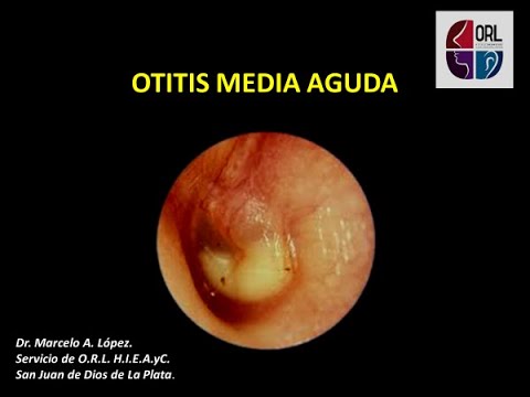 Vídeo: Com s’obté l’otitis mitjana aguda?