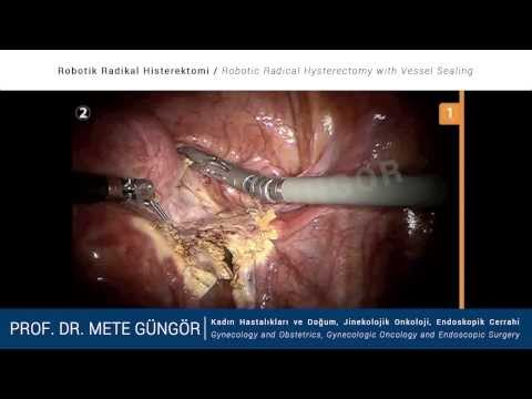 Robotik Radikal Histerektomi - Robotic Radical Hysterectomy with Vessel Sealing Device / Da Vinci